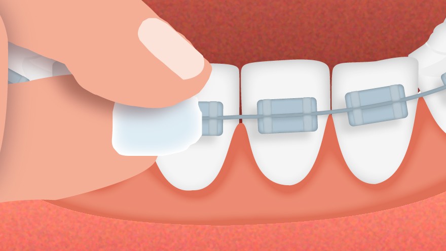 Orthodontic wax being applied