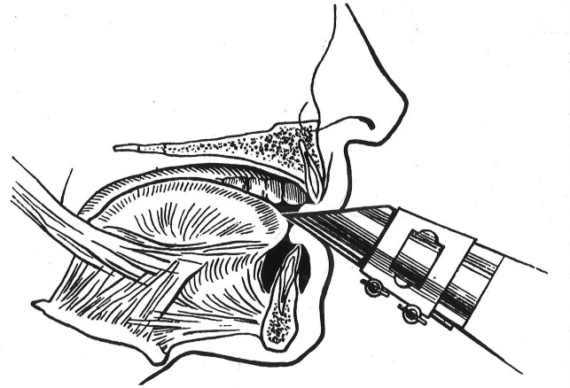 Drawing of a single lip embouchure on the clarinet